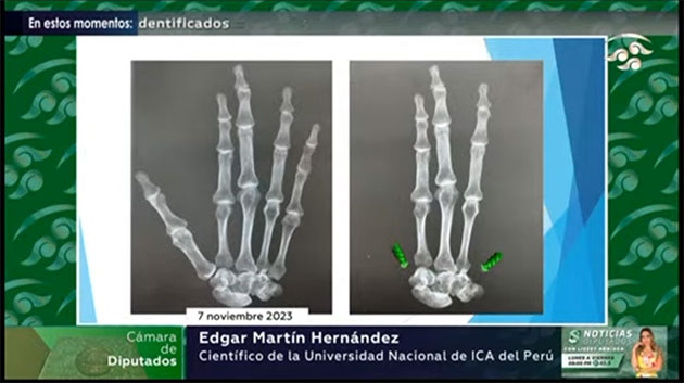 Veranschaulichung der durch die Entfernung von Daumen- und Fingerknochen entstehenden Lücken im normalen fünffingrigen Handskelett.Quelle: Vortrag Edgar Martin Hernandez am 7.11.23 / Canal del Congreso México (Youtube)