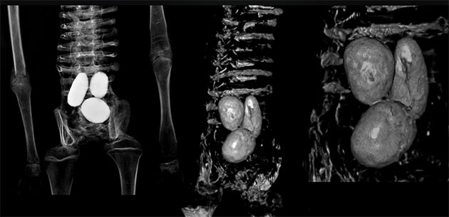 CT-Scan der drei „Eier“ im Bauchraum einer der kleinen Mumien.Quelle: Dr. J. Benoit / Kanal: Luca. (Youtube)